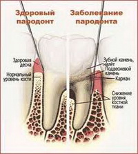 Заболевание породонта при неправильной гигиене зубов