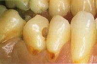 Streptococcus mutans - причина возникновения кариеса зубов
